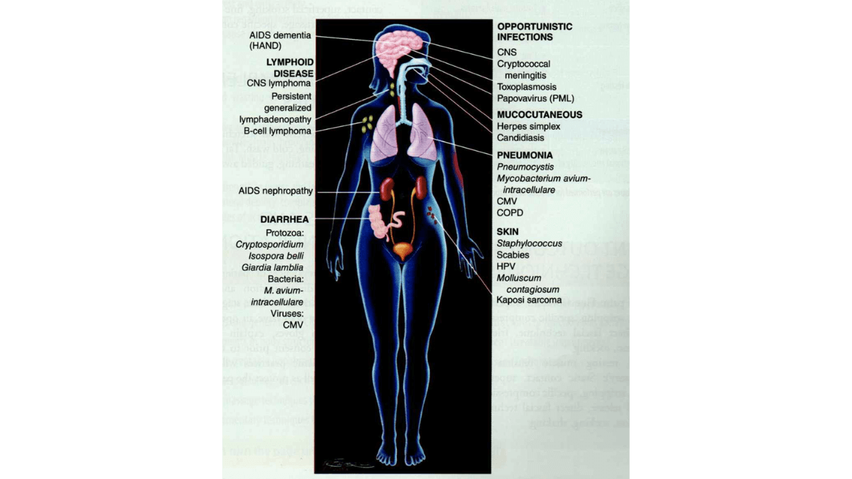 Žmogaus Imunodeficito Virusinė Infekcija. Pvaizduota iliustracija iš knygos Outcome-Based Massage Across the Continuum of care Fourth Edition.