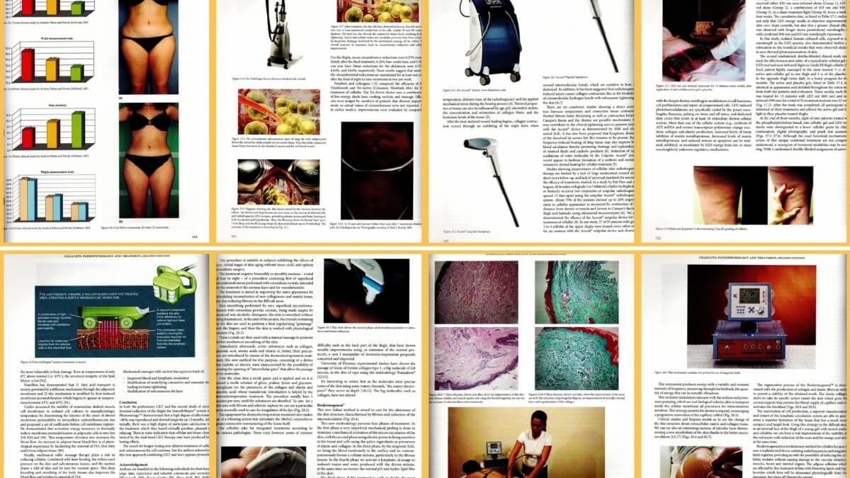 Knyga Cellulite Pathophysiology And Treatment. Pateiktos iliustracijos iš knygos Cellulite Pathophysiology And Treatment.