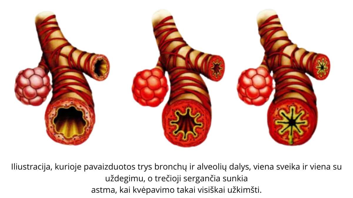 Astma: Kvėpavimo Takų Liga | Priežastys 02. Pateikta iliustracija iš knygos Outcome-Based Massage: Across the Continuum of Care Fourth Edition.