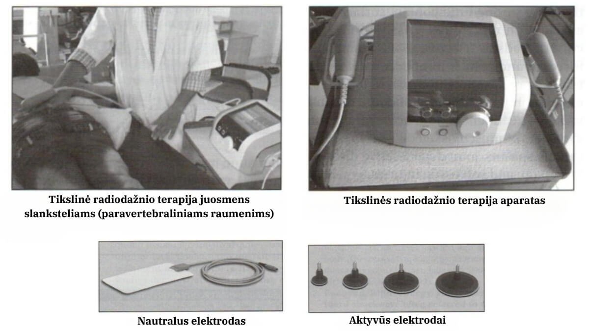 Tikslinė Radiodažnio Terapija (Targeted Radiofrequency Therapy). Iliustracijos paimtos iš knygos Electrotherapy Simplified Third Edition.