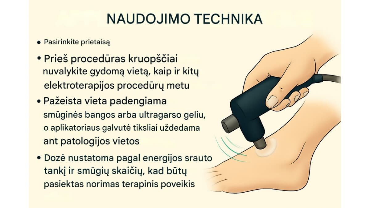Smūginės Bangos Terapija (Shockwave Therapy). Pateiktos iliustracija smūginės bangos taikymo technika.