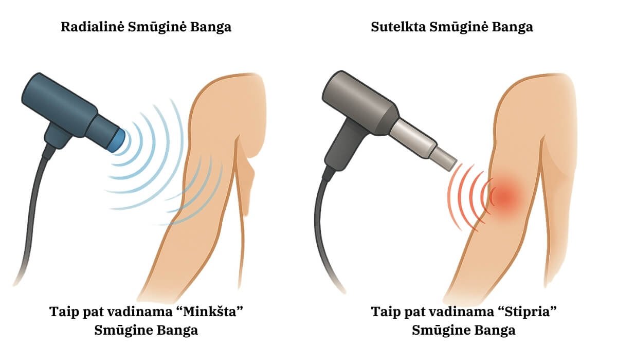 Smūginės Bangos Terapija (Shockwave Therapy). Pateikti Du Iš Esmės Skirtingi Smūginių Bangų Tipai.