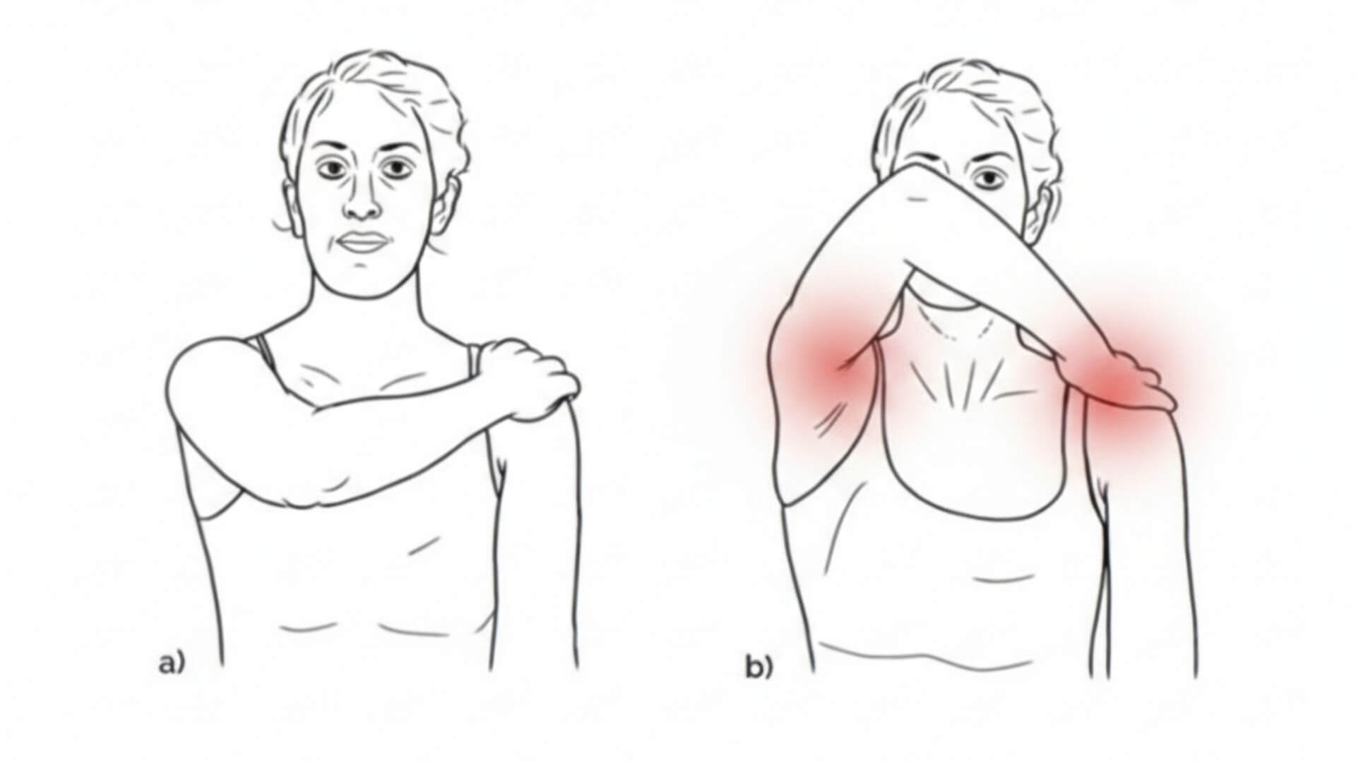 Antdyglinis Raumuo (Supraspinatus) Peties Skausmo Testavimas Antdyglinis Raumuo (Supraspinatus) Peties Skausmo Testavimas. Yocum testas peties ankštumo sindromo ir supraspinatus sausgyslės dirginimo vertinimui.