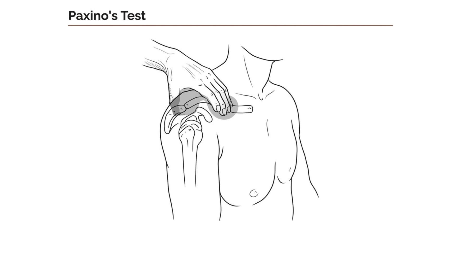 Akromioklavikulinio Sąnario Testavimas (Acromioclavicular Joint Test) Akromioklavikulinio Sąnario Testavimas (Acromioclavicular Joint Test). Paxino testas: pacientui sėdint, specialisto nykštys spaudžia mentės petinės ataugos sritį, o pirštais spaudžiamas raktikaulis, provokuojant AC sąnario skausmą.