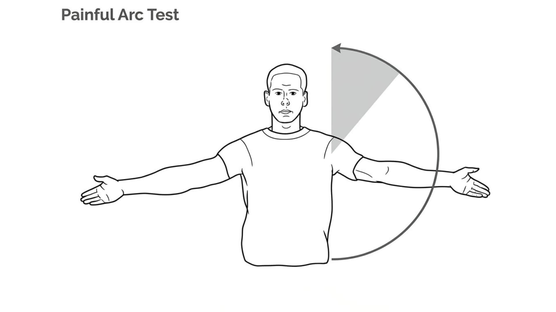 Akromioklavikulinio Sąnario Testavimas (Acromioclavicular Joint Test) Akromioklavikulinio Sąnario Testavimas (Acromioclavicular Joint Test). Skausmingo lanko testas: pacientas aktyviai atitraukia ranką per visą judesio amplitudę, vertinant skausmą peties srityje, ypač 140–180° elevacijos metu.